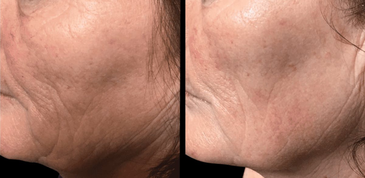Geneo Before & After Gallery - Patient 259912 - Image 1