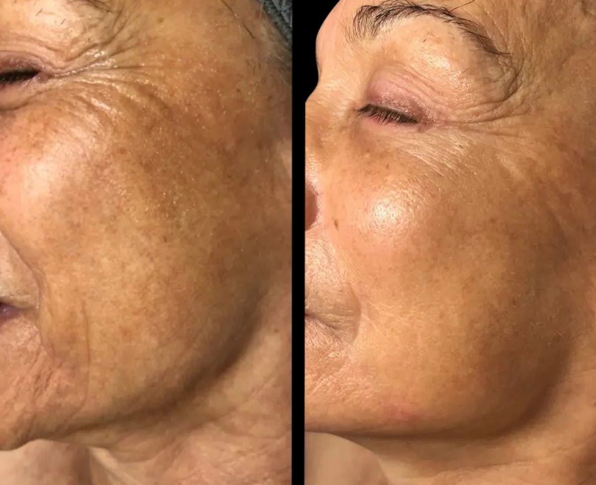 Geneo Before & After Gallery - Patient 383342 - Image 1