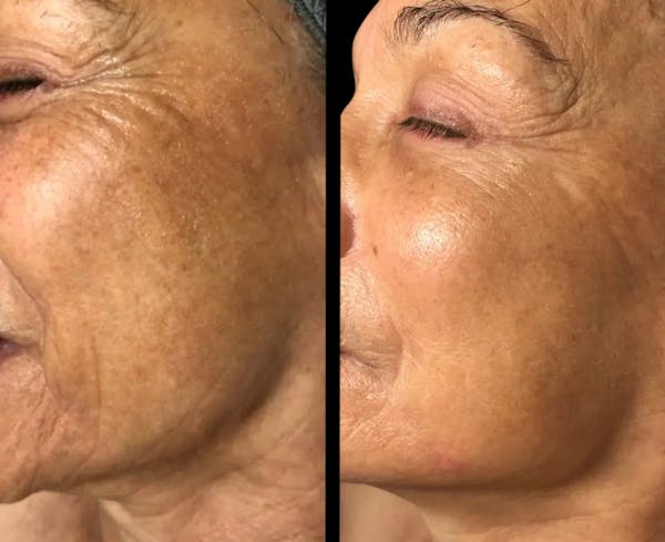 Geneo Before & After Gallery - Patient 383342 - Image 1