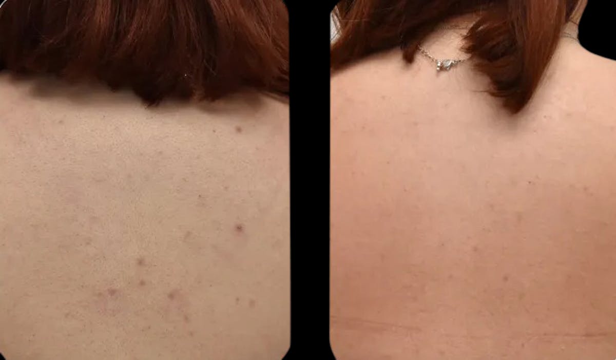 Geneo Before & After Gallery - Patient 338615 - Image 1