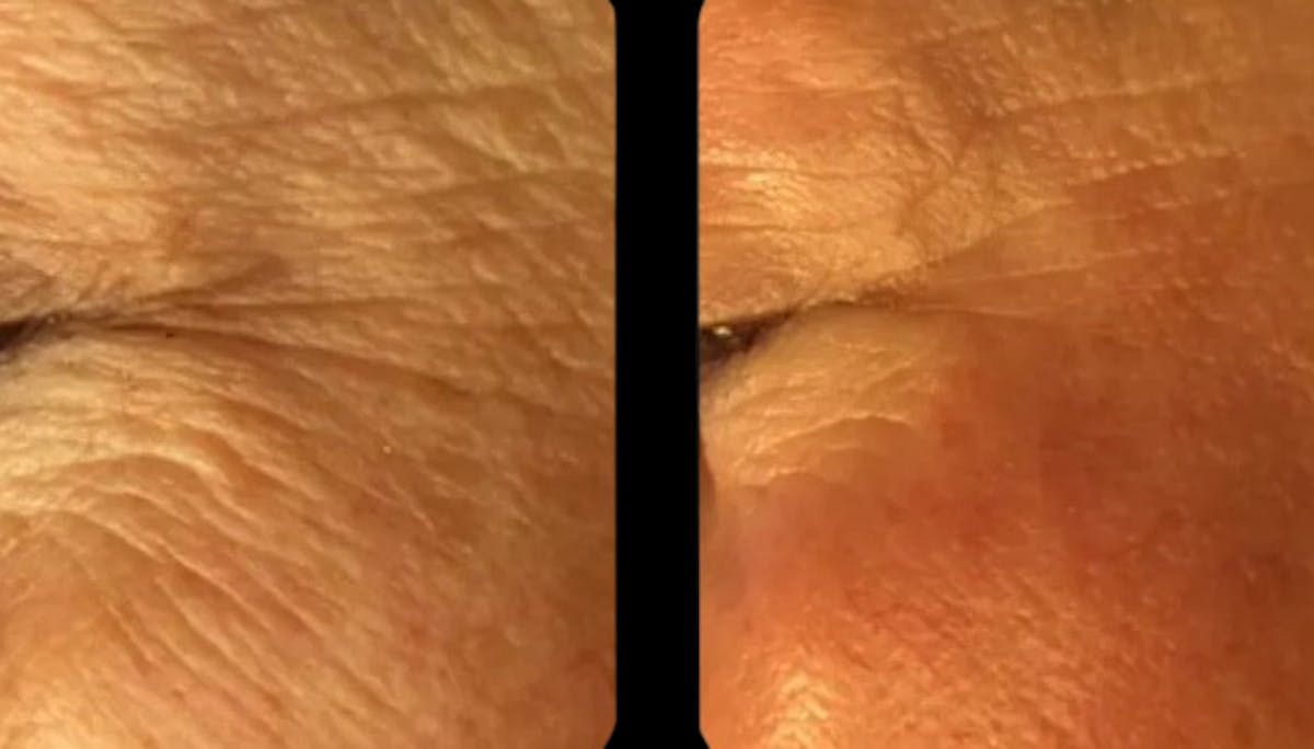 Geneo Before & After Gallery - Patient 311460 - Image 1