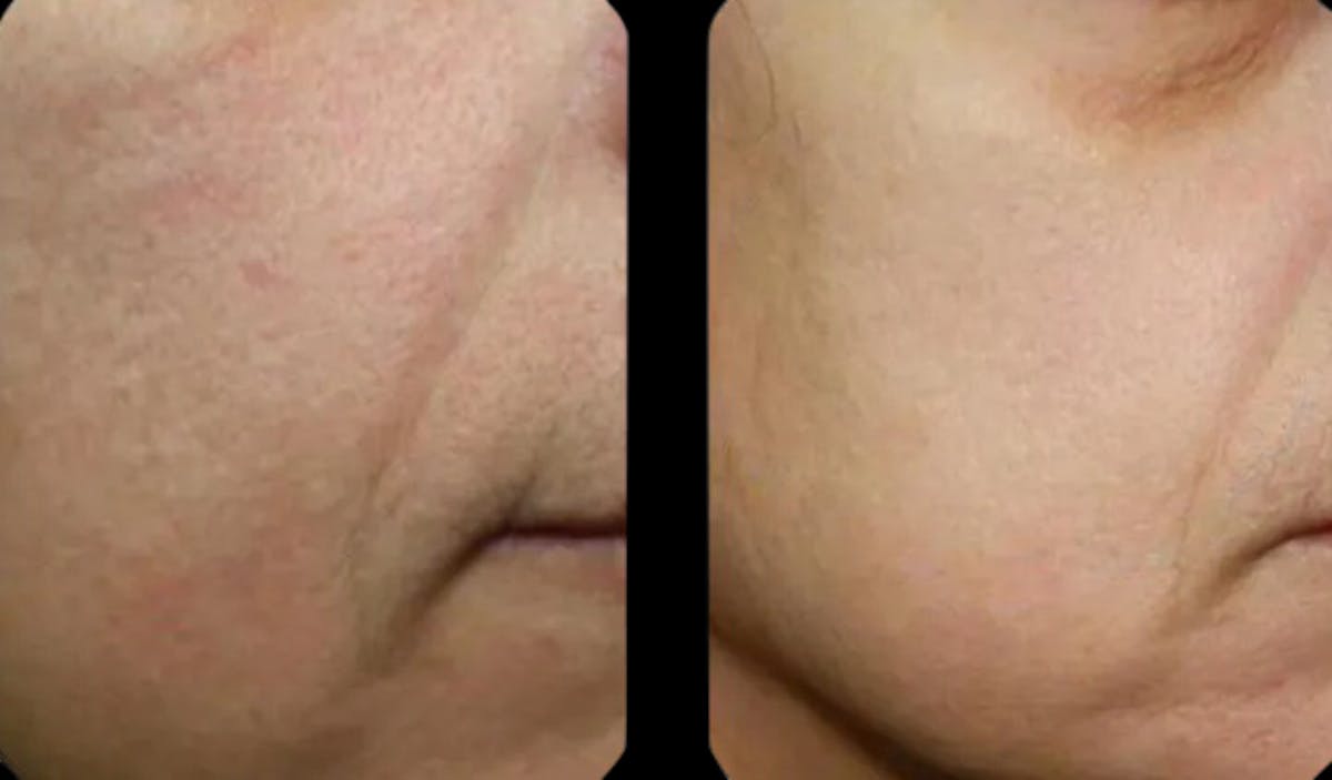 Geneo Before & After Gallery - Patient 265295 - Image 1