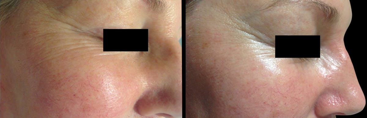 Geneo Before & After Gallery - Patient 201610 - Image 1