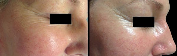 Geneo Before & After Gallery - Patient 201610 - Image 1