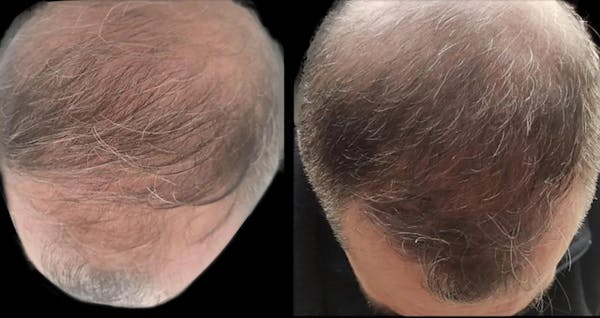 Exosomes Before & After Gallery - Patient 263599 - Image 1