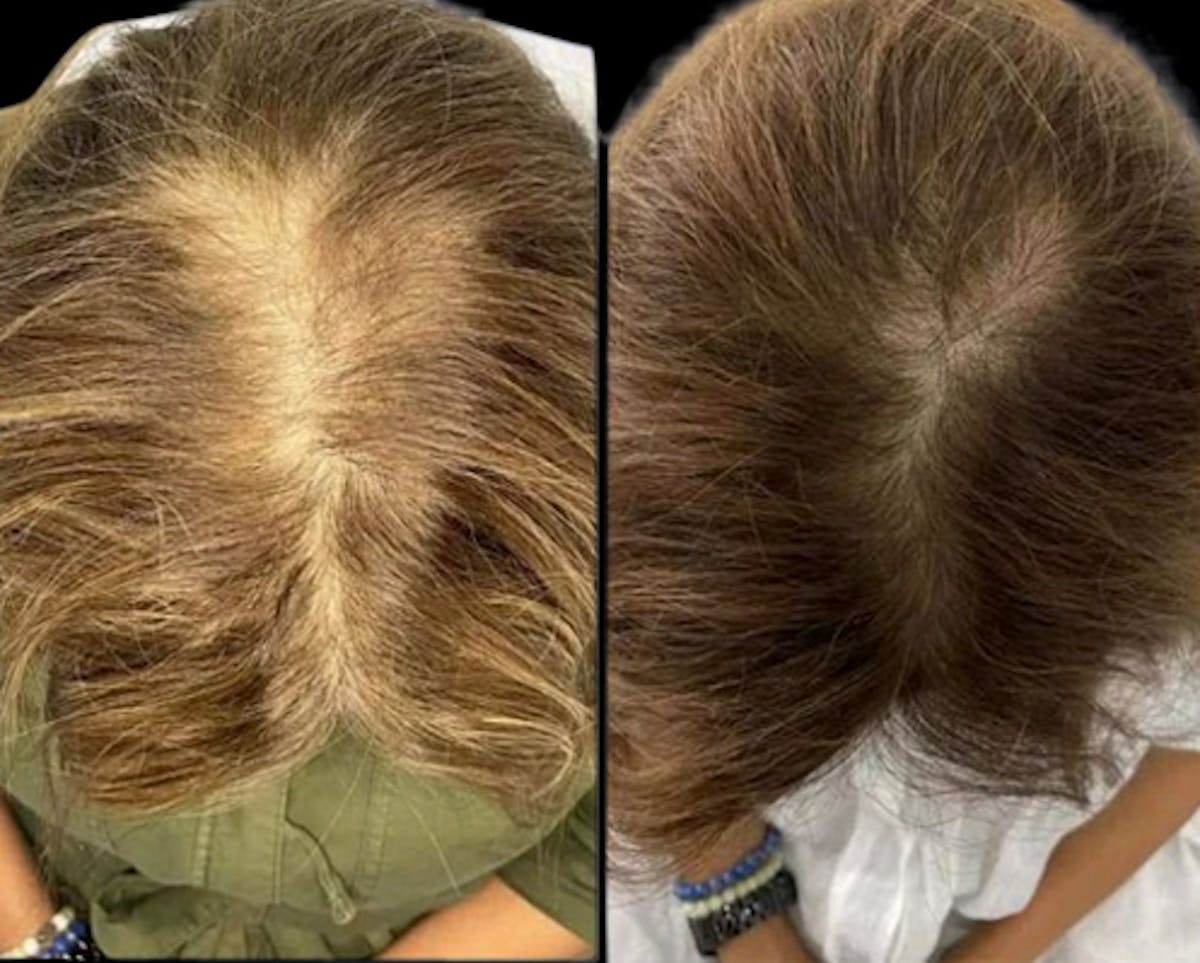Exosomes Before & After Gallery - Patient 151721 - Image 1