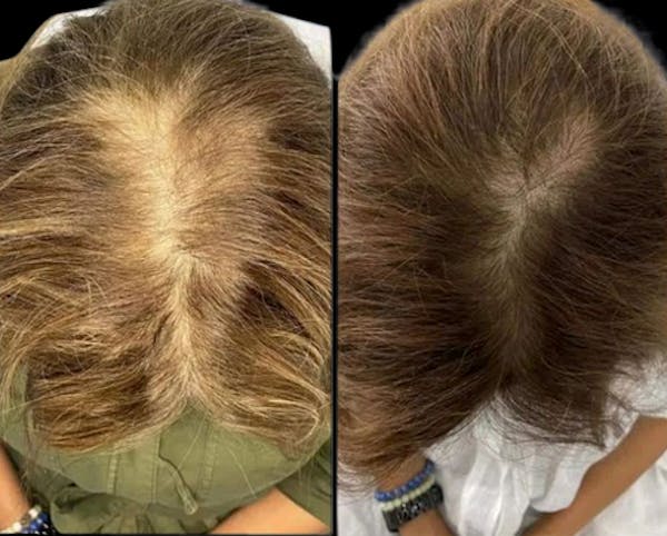 Exosomes Before & After Gallery - Patient 151721 - Image 1