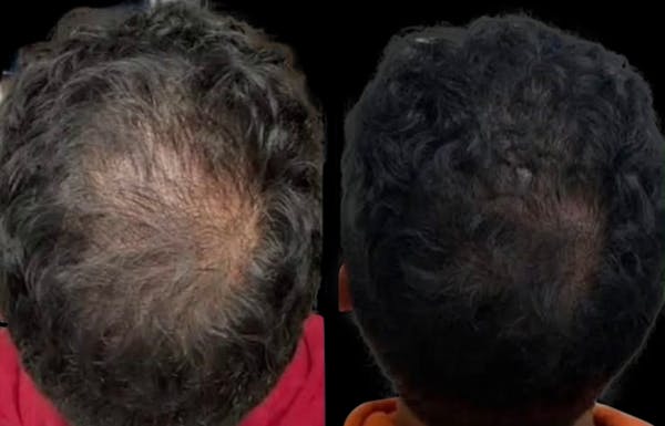 Hair Restoration Before & After Gallery - Patient 129436 - Image 1
