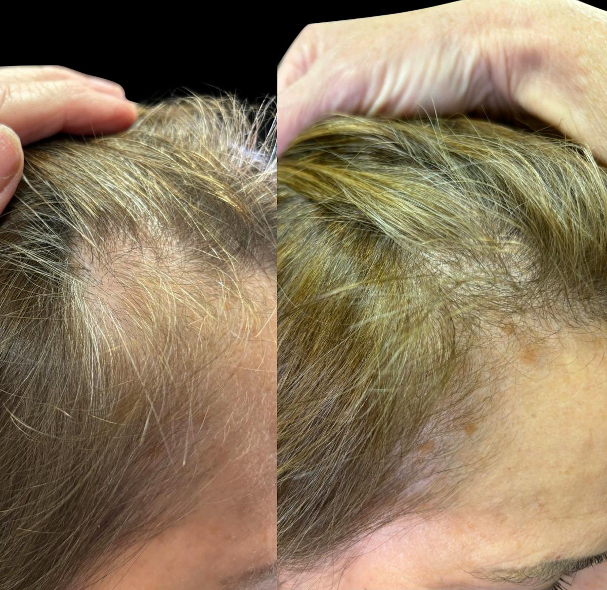 Exosomes Before & After Gallery - Patient 164371 - Image 1