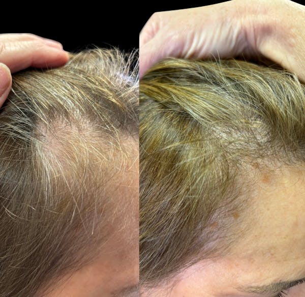 Hair Restoration Before & After Gallery - Patient 319168 - Image 1