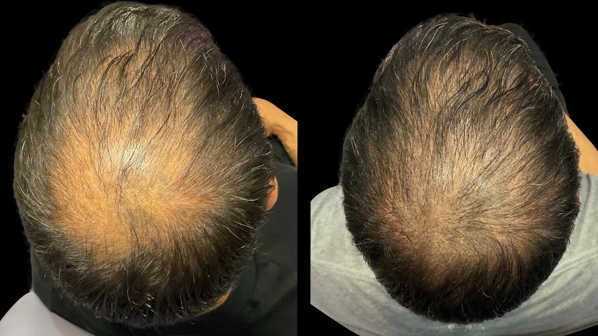 Exosomes Before & After Gallery - Patient 103046 - Image 1