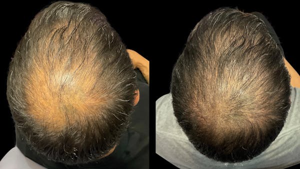 Hair Restoration Before & After Gallery - Patient 858863 - Image 1