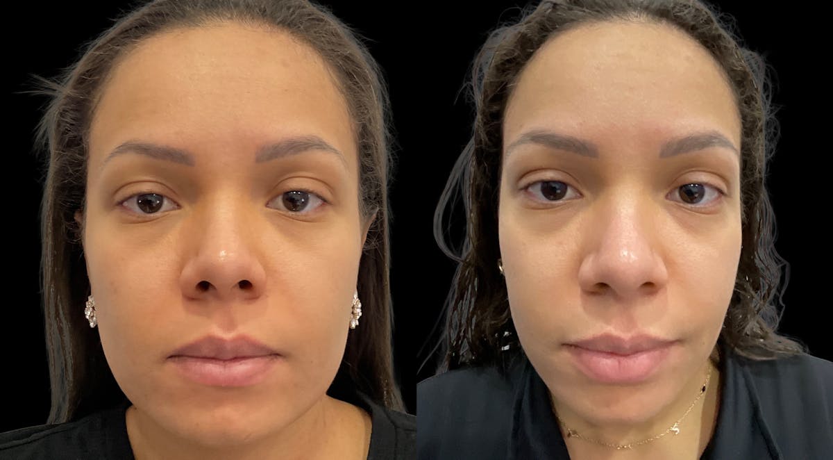 Hydrafacial Before & After Gallery - Patient 276302 - Image 2