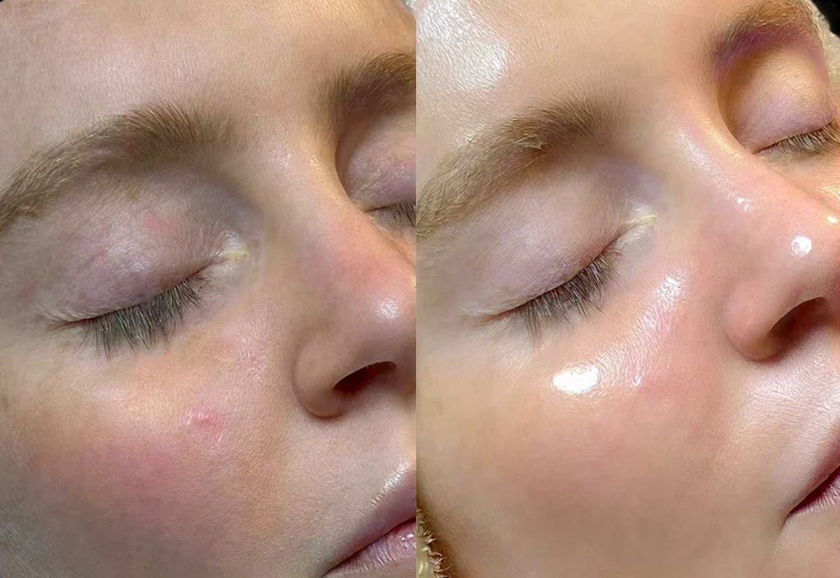 Hydrafacial Before & After Gallery - Patient 303976 - Image 1