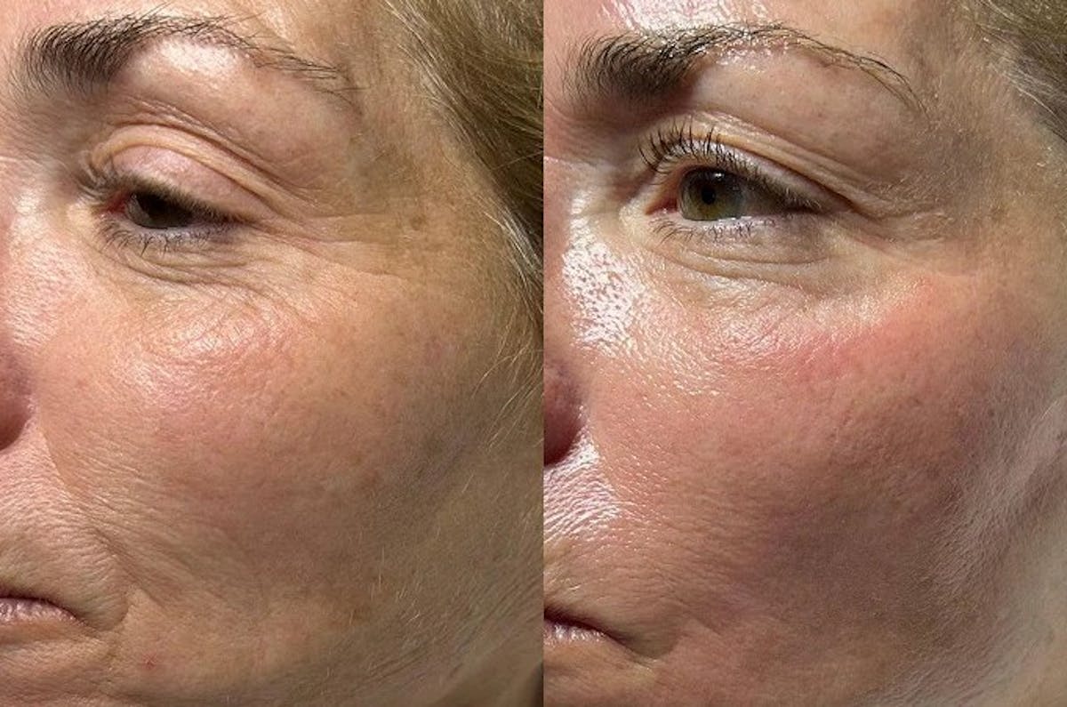 Hydrafacial Before & After Gallery - Patient 286612 - Image 1