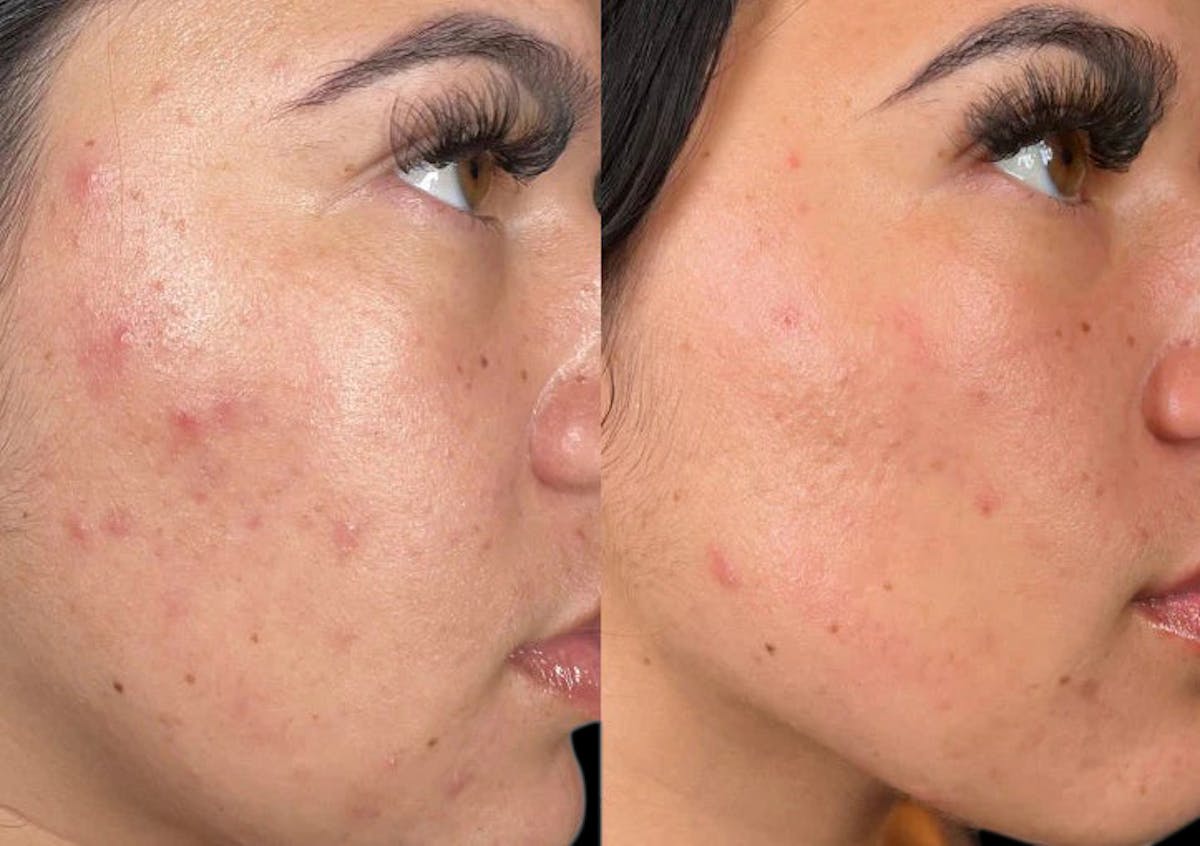 Hydrafacial Before & After Gallery - Patient 240403 - Image 1