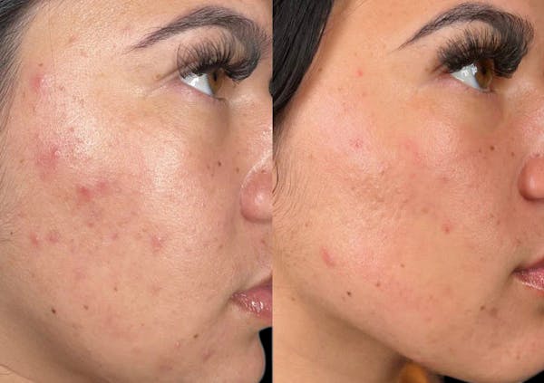 Hydrafacial Before & After Gallery - Patient 240403 - Image 1