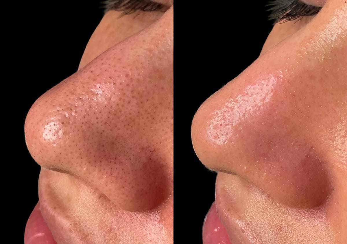 Hydrafacial Before & After Gallery - Patient 107199 - Image 1