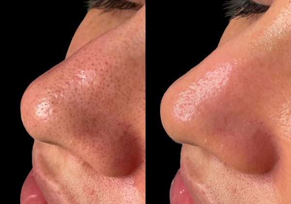 Hydrafacial Before & After Gallery - Patient 107199 - Image 1