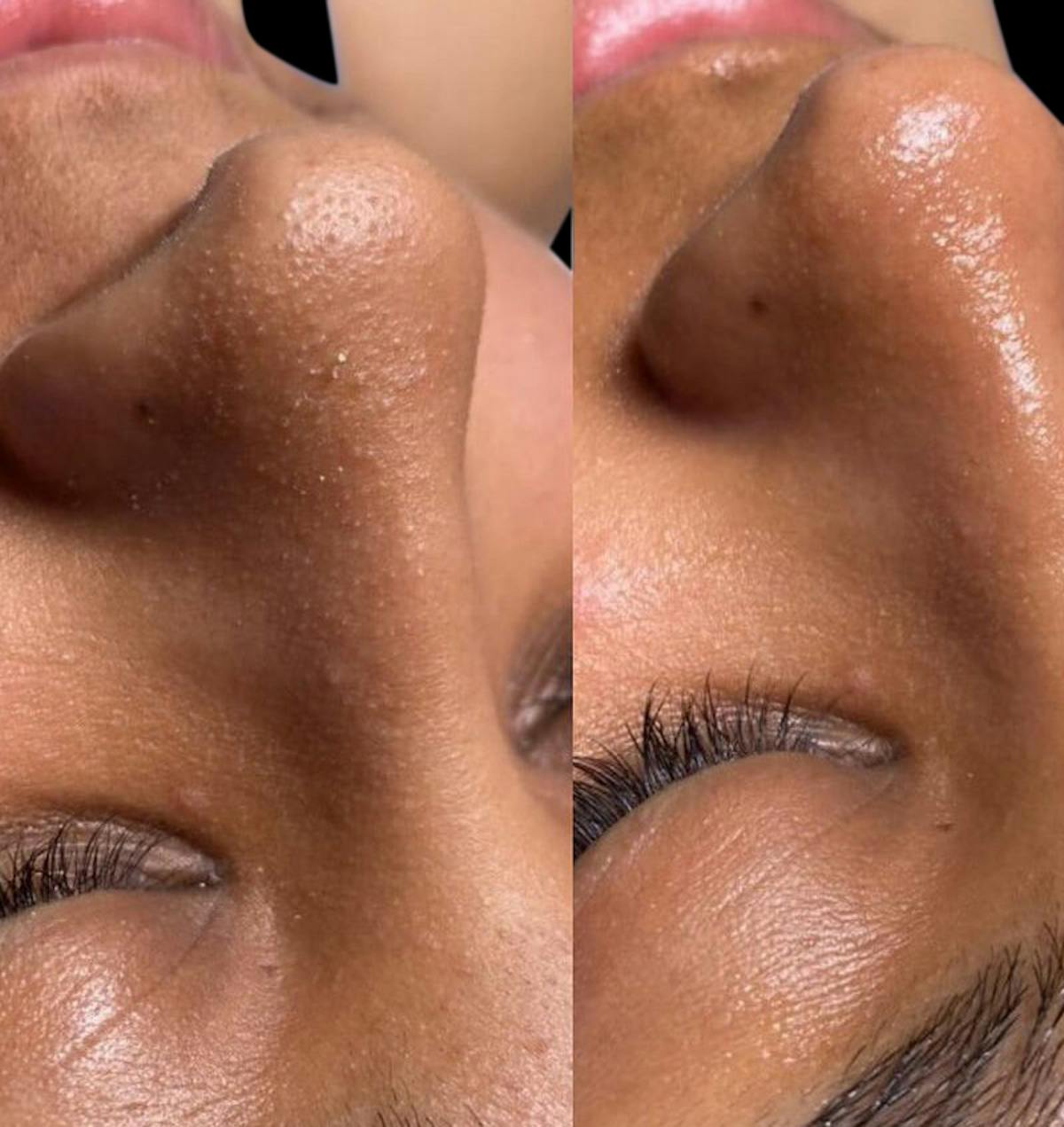 Hydrafacial Before & After Gallery - Patient 119545 - Image 1