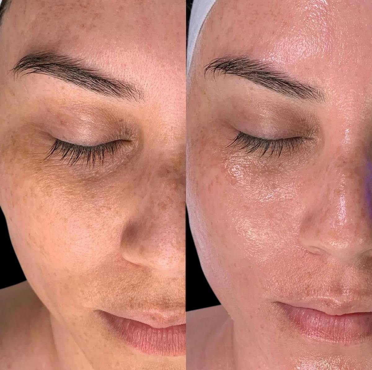 Hydrafacial Before & After Gallery - Patient 228386 - Image 1