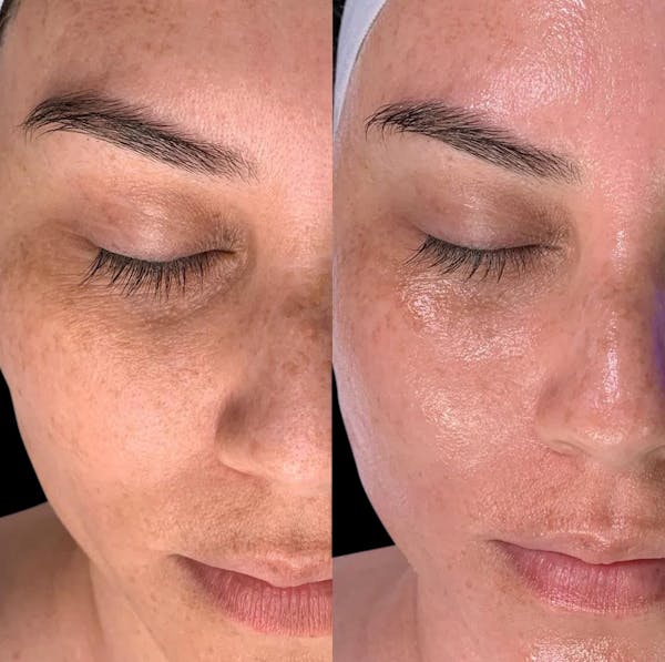 Hydrafacial Before & After Gallery - Patient 228386 - Image 1