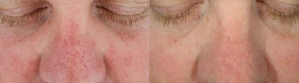 Hydrafacial Before & After Gallery - Patient 114242 - Image 1