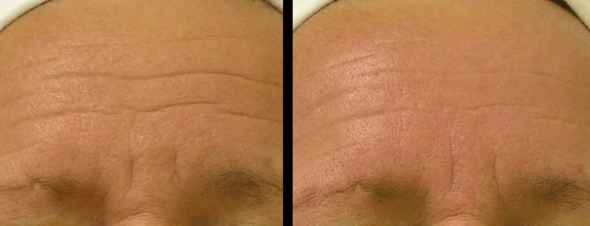 Hydrafacial Before & After Gallery - Patient 184902 - Image 1