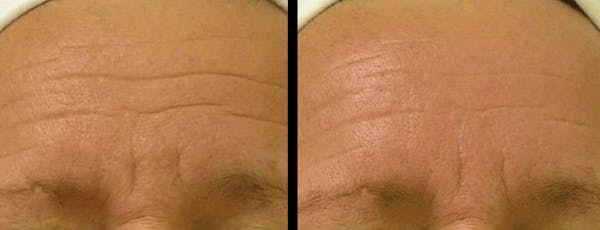 Hydrafacial Before & After Gallery - Patient 184902 - Image 1