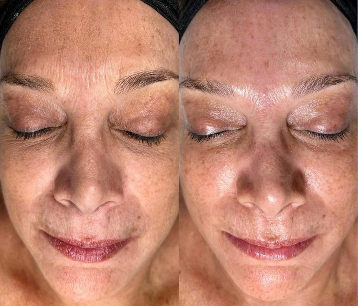 Hydrafacial Before & After Gallery - Patient 250206 - Image 1