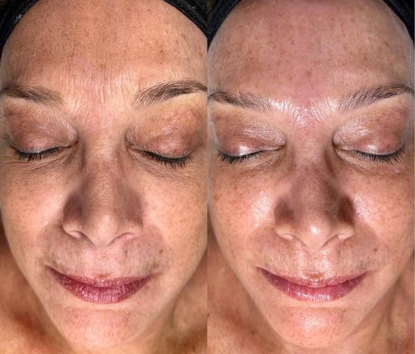 Hydrafacial Before & After Gallery - Patient 250206 - Image 1