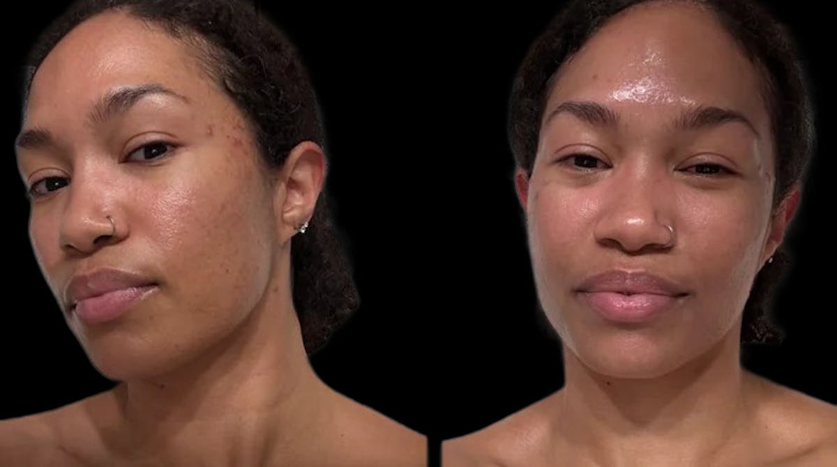 Hydrafacial Before & After Gallery - Patient 248503 - Image 1