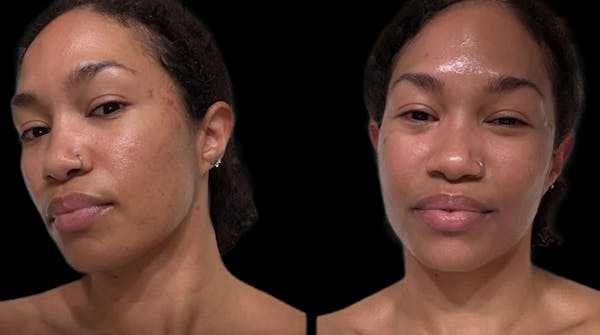 Hydrafacial Before & After Gallery - Patient 248503 - Image 1