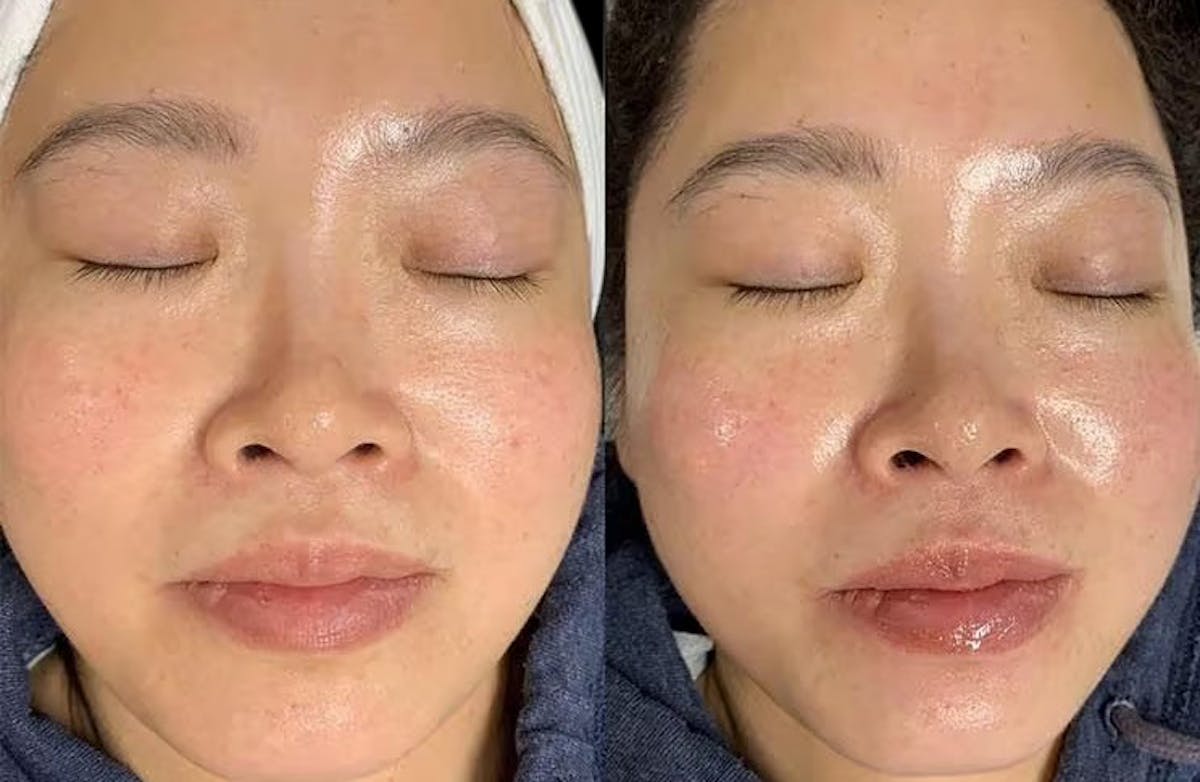 Hydrafacial Before & After Gallery - Patient 615177 - Image 1