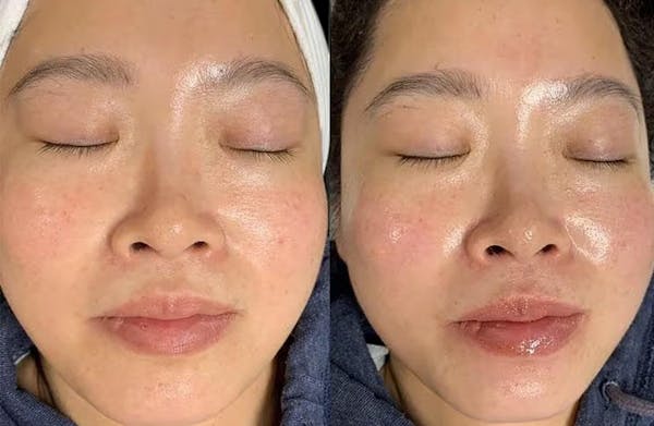 Hydrafacial Before & After Gallery - Patient 615177 - Image 1