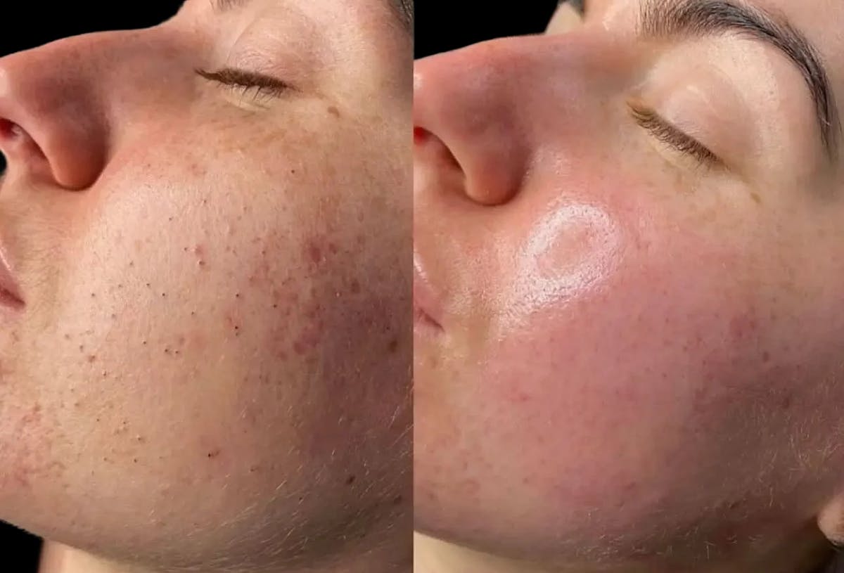Hydrafacial Before & After Gallery - Patient 316043 - Image 1