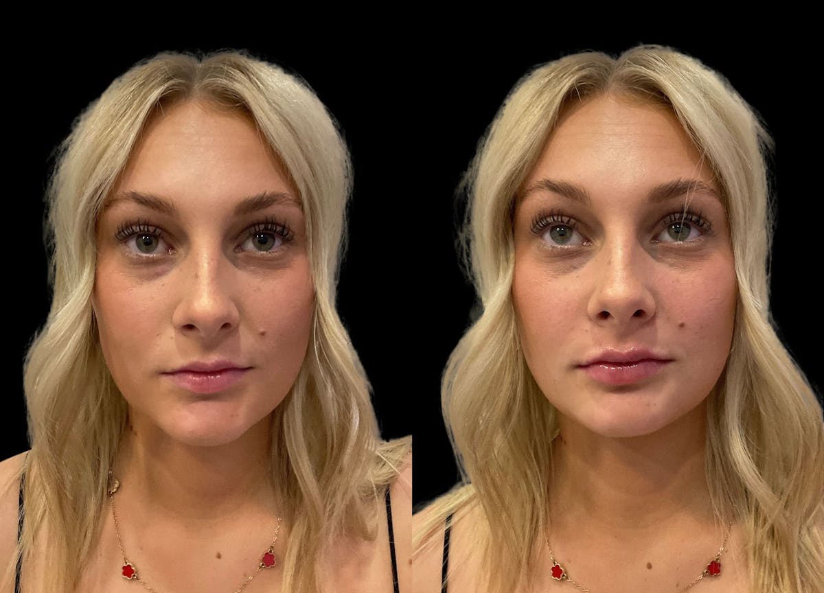 Lip Filler Before & After Gallery - Patient 386755 - Image 3
