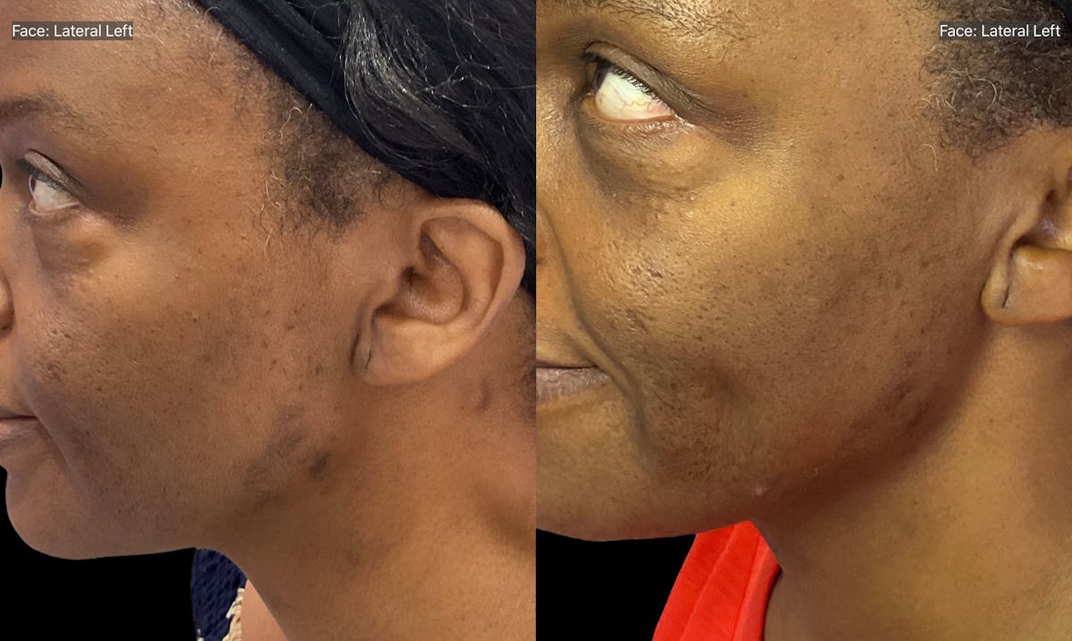 Medical Grade Facials Before & After Gallery - Patient 114674 - Image 2