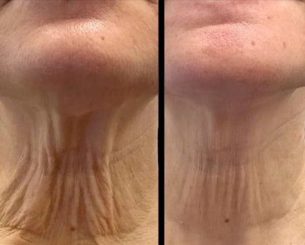 Exosomes Before & After Gallery - Patient 552051 - Image 1