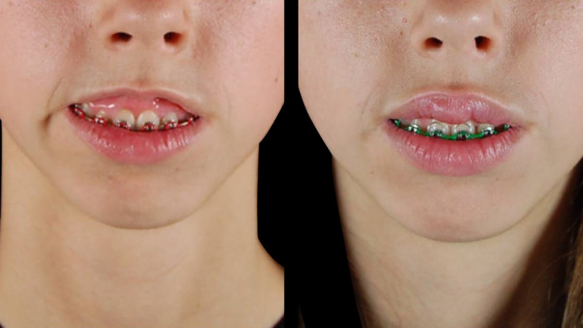 Neurotoxins Before & After Gallery - Patient 341944 - Image 1