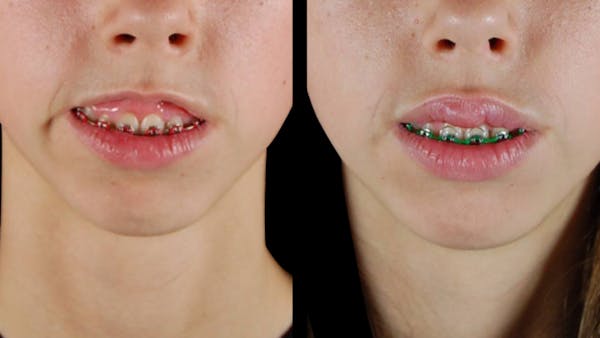Neurotoxins Before & After Gallery - Patient 341944 - Image 1