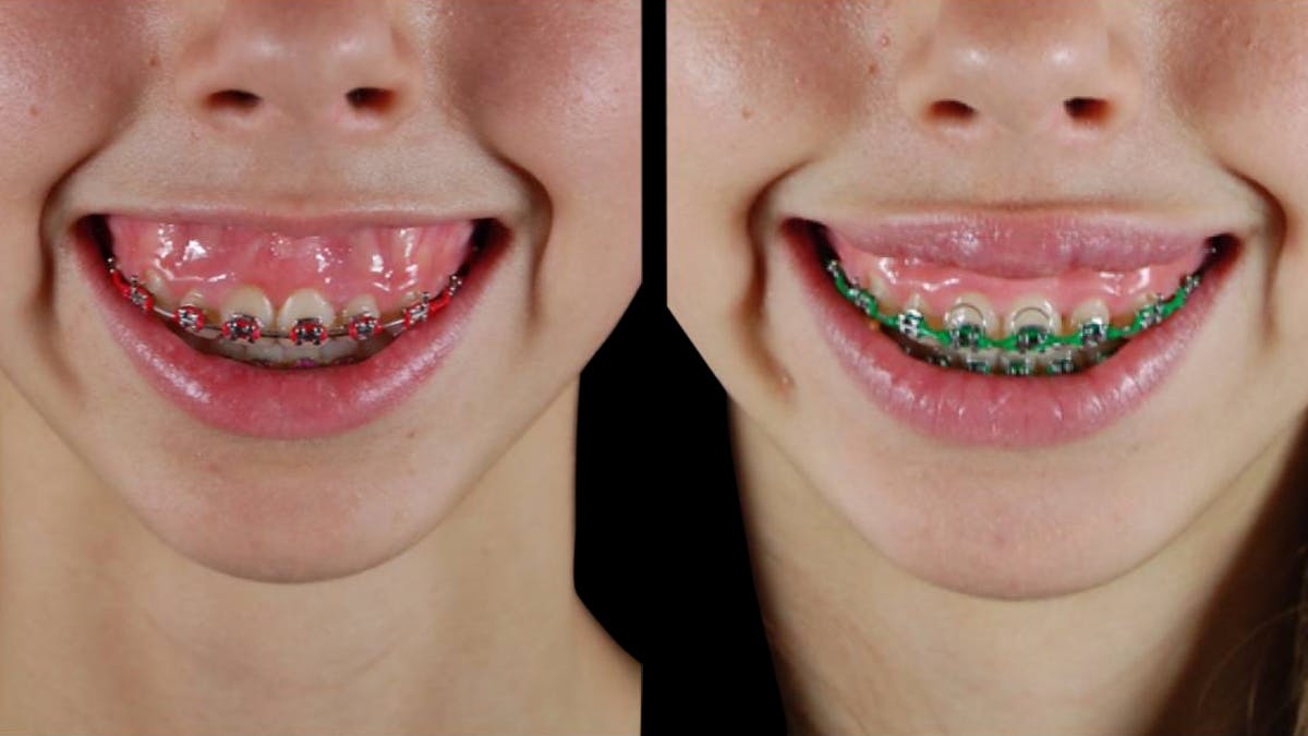 Neurotoxins Before & After Gallery - Patient 341944 - Image 2