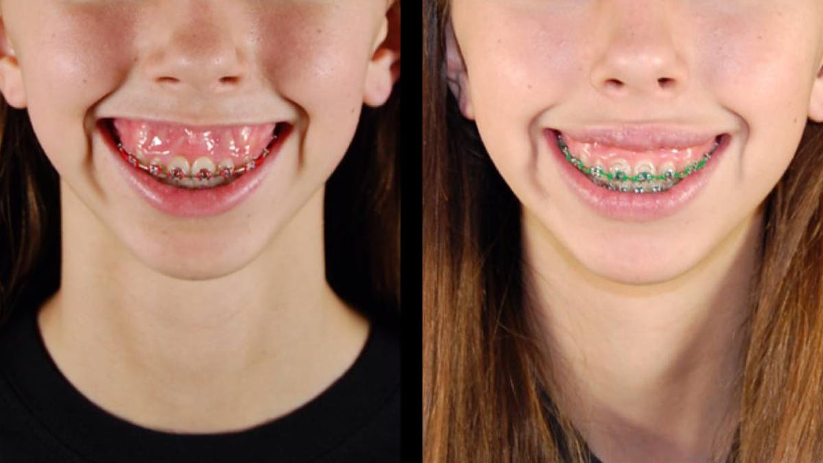 Neurotoxins Before & After Gallery - Patient 341944 - Image 3
