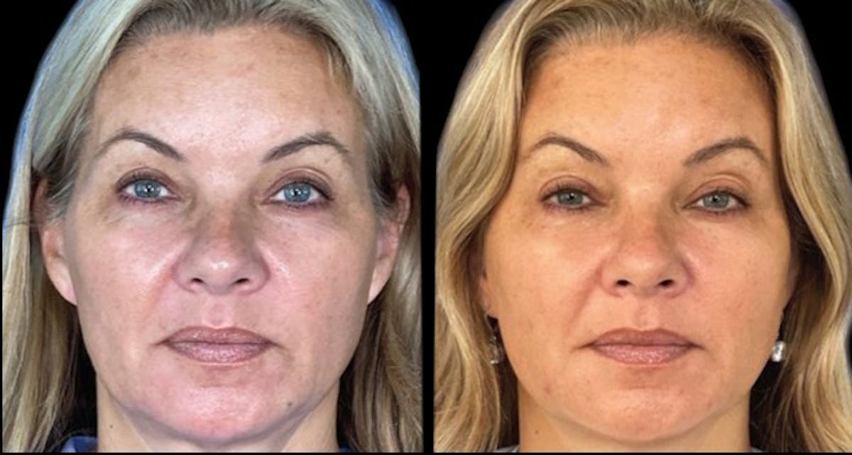 PDO Threads Before & After Gallery - Patient 408600 - Image 1
