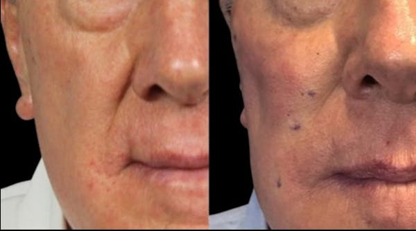 PDO Threads Before & After Gallery - Patient 245346 - Image 1
