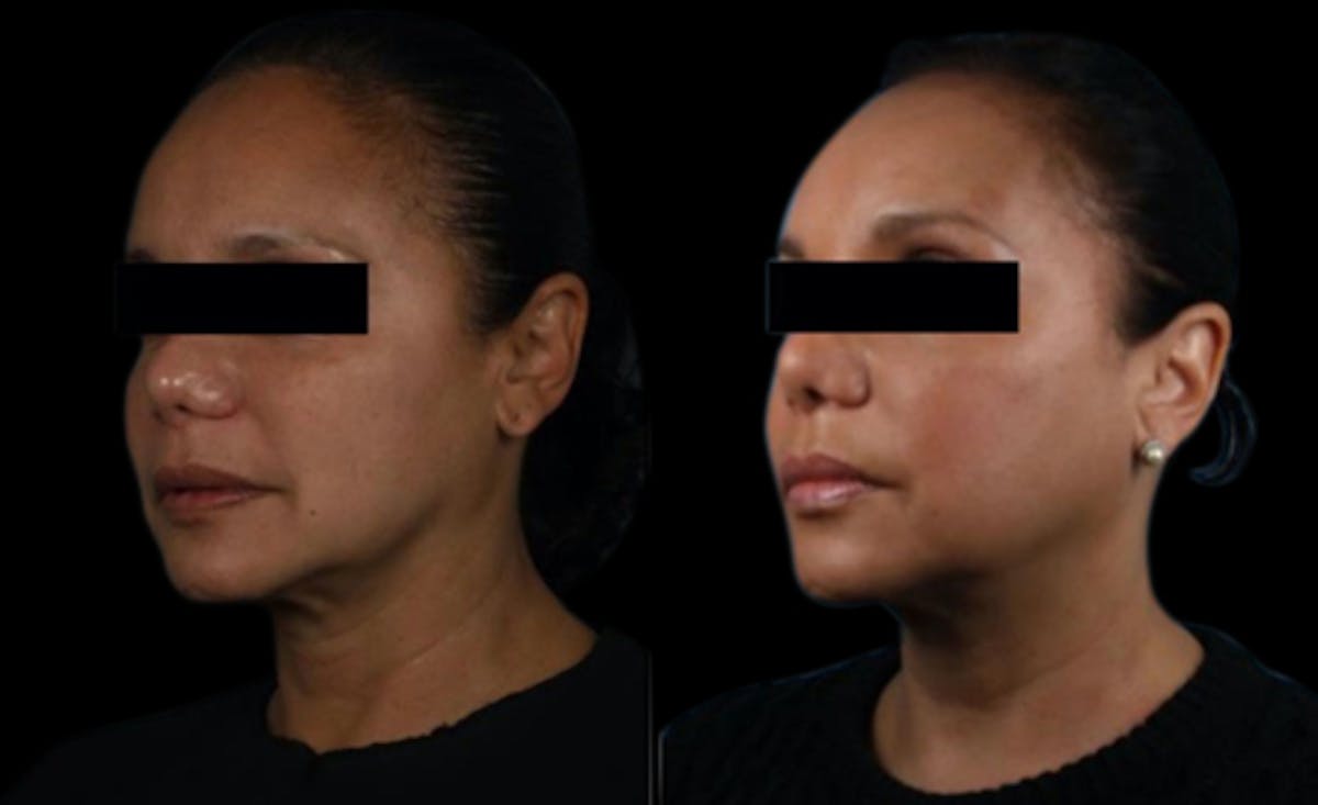 PDO Threads Before & After Gallery - Patient 194047 - Image 1