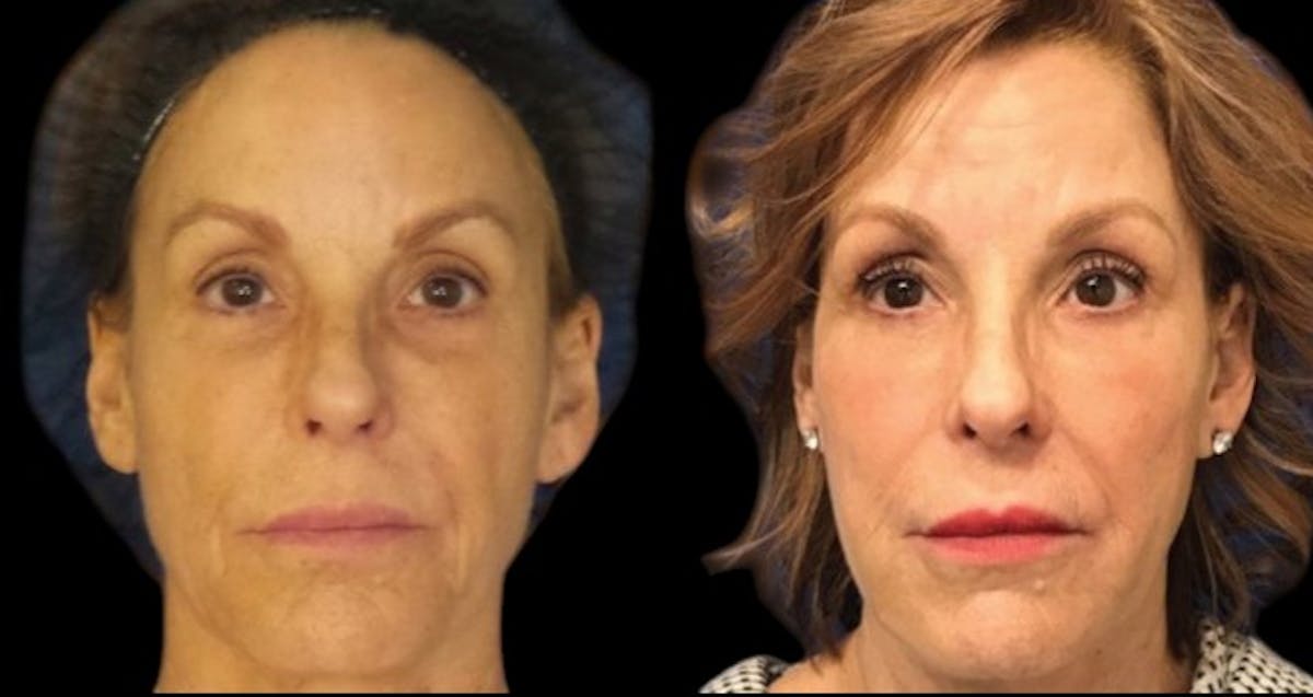 PDO Threads Before & After Gallery - Patient 105506 - Image 1