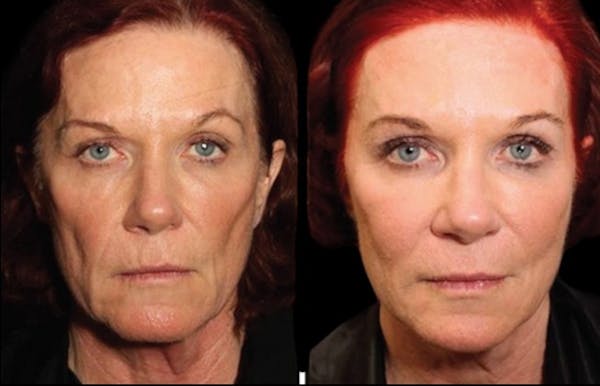 PDO Threads Before & After Gallery - Patient 400281 - Image 1