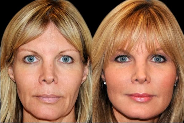 PDO Threads Before & After Gallery - Patient 190241 - Image 1