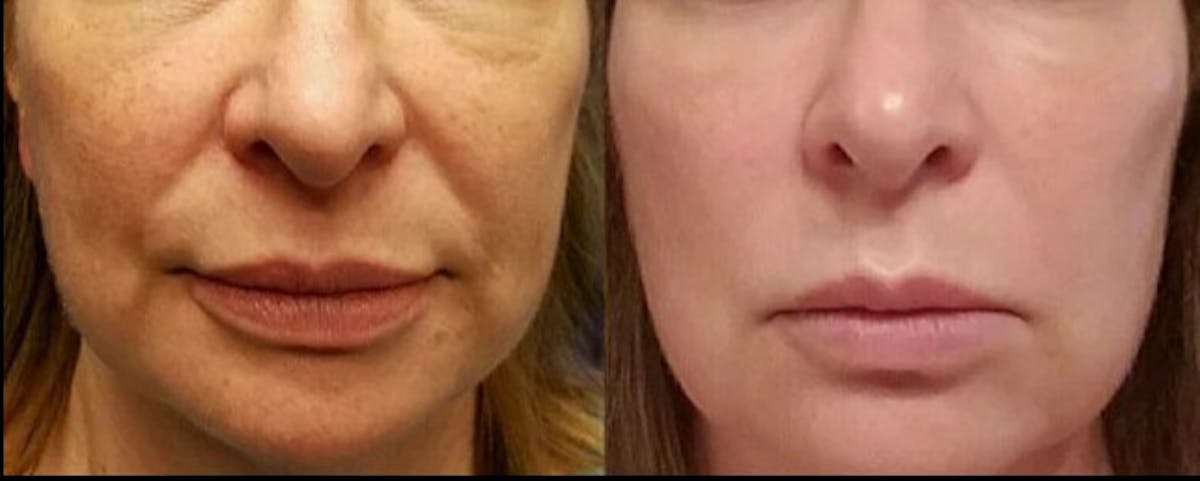 PDO Threads Before & After Gallery - Patient 447319 - Image 1